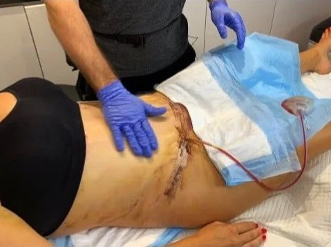 Post-surgical Care